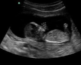 course-9 1st Trimester Ultrasound - Blended