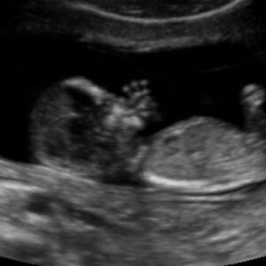 1st trimester