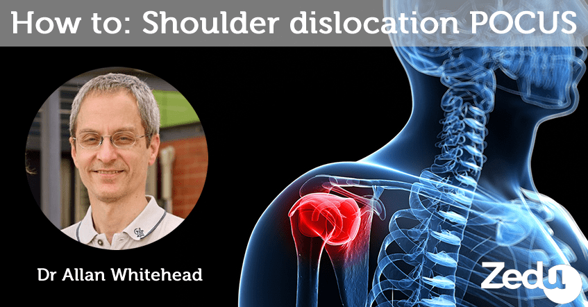How to: Shoulder dislocation POCUS
